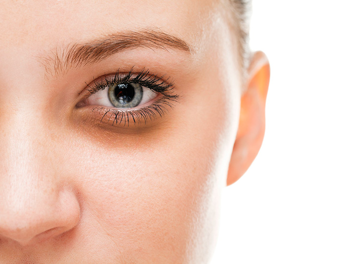 What’s your under-eye circle type?